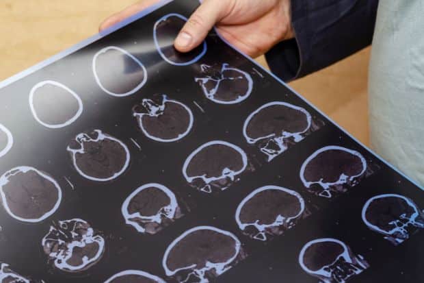 Syracuse Traumatic Brain Injuries